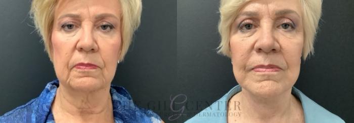 Eyelid Lift Case 689 Before & After Front | The Woodlands, TX | The Gill Center for Plastic Surgery and Dermatology