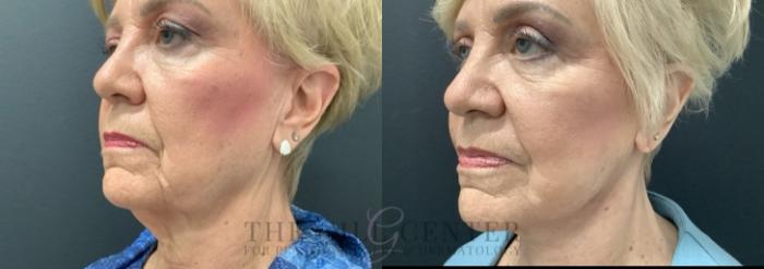 Eyelid Lift Case 689 Before & After Left Side | The Woodlands, TX | The Gill Center for Plastic Surgery and Dermatology