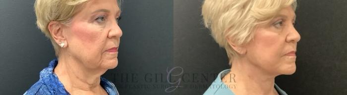 Eyelid Lift Case 689 Before & After Right Side | The Woodlands, TX | The Gill Center for Plastic Surgery and Dermatology