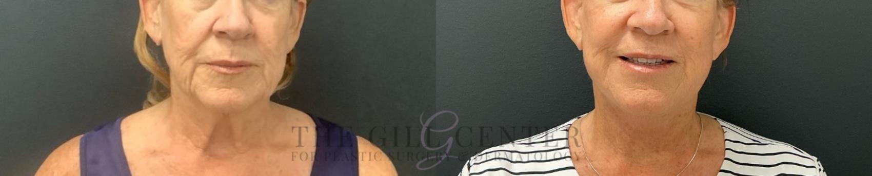Face & Neck Lift Case 717 Before & After Front | The Woodlands, TX | The Gill Center for Plastic Surgery and Dermatology
