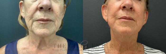 Face & Neck Lift Case 717 Before & After Front lower face/neck | The Woodlands, TX | The Gill Center for Plastic Surgery and Dermatology