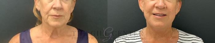 Face & Neck Lift Case 717 Before & After Front | The Woodlands, TX | The Gill Center for Plastic Surgery and Dermatology