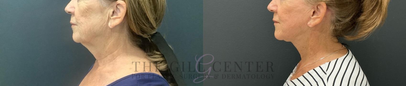 Face & Neck Lift Case 717 Before & After Left Side | The Woodlands, TX | The Gill Center for Plastic Surgery and Dermatology