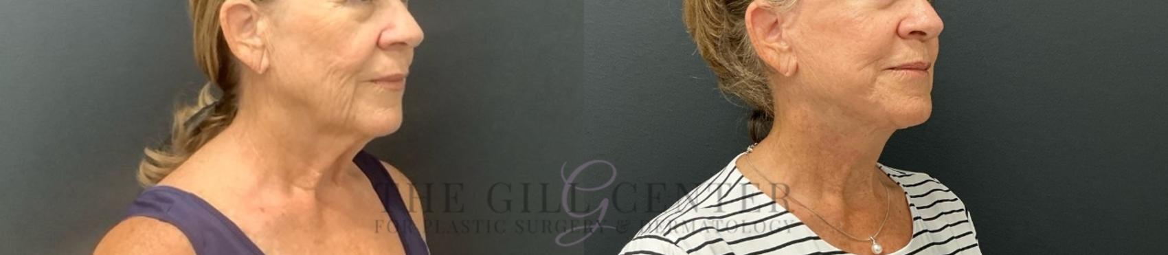 Face & Neck Lift Case 717 Before & After Right quarter turn | The Woodlands, TX | The Gill Center for Plastic Surgery and Dermatology