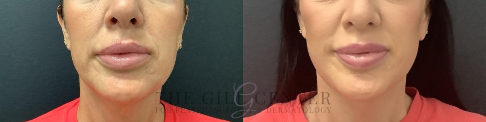 Face & Neck Lift Case 736 Before & After Front | The Woodlands, TX | The Gill Center for Plastic Surgery and Dermatology