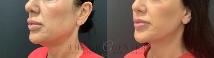 Face & Neck Lift Case 736 Before & After Left Oblique | The Woodlands, TX | The Gill Center for Plastic Surgery and Dermatology