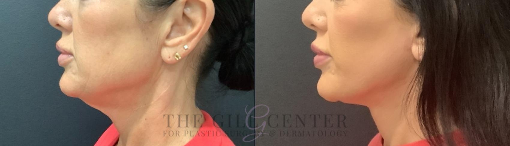 Face & Neck Lift Case 736 Before & After Left Side | The Woodlands, TX | The Gill Center for Plastic Surgery and Dermatology