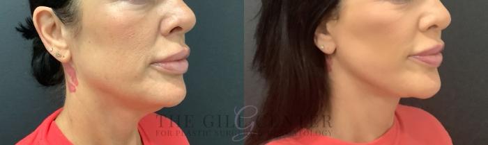 Face & Neck Lift Case 736 Before & After Right Oblique | The Woodlands, TX | The Gill Center for Plastic Surgery and Dermatology