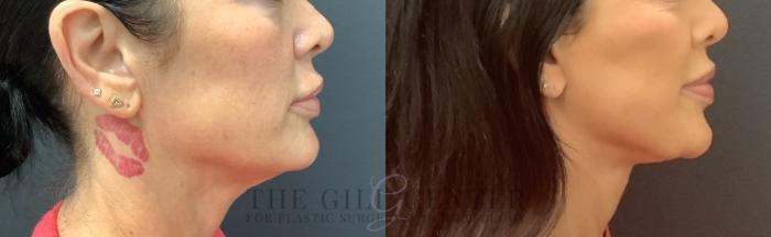 Face & Neck Lift Case 736 Before & After Right Side | The Woodlands, TX | The Gill Center for Plastic Surgery and Dermatology