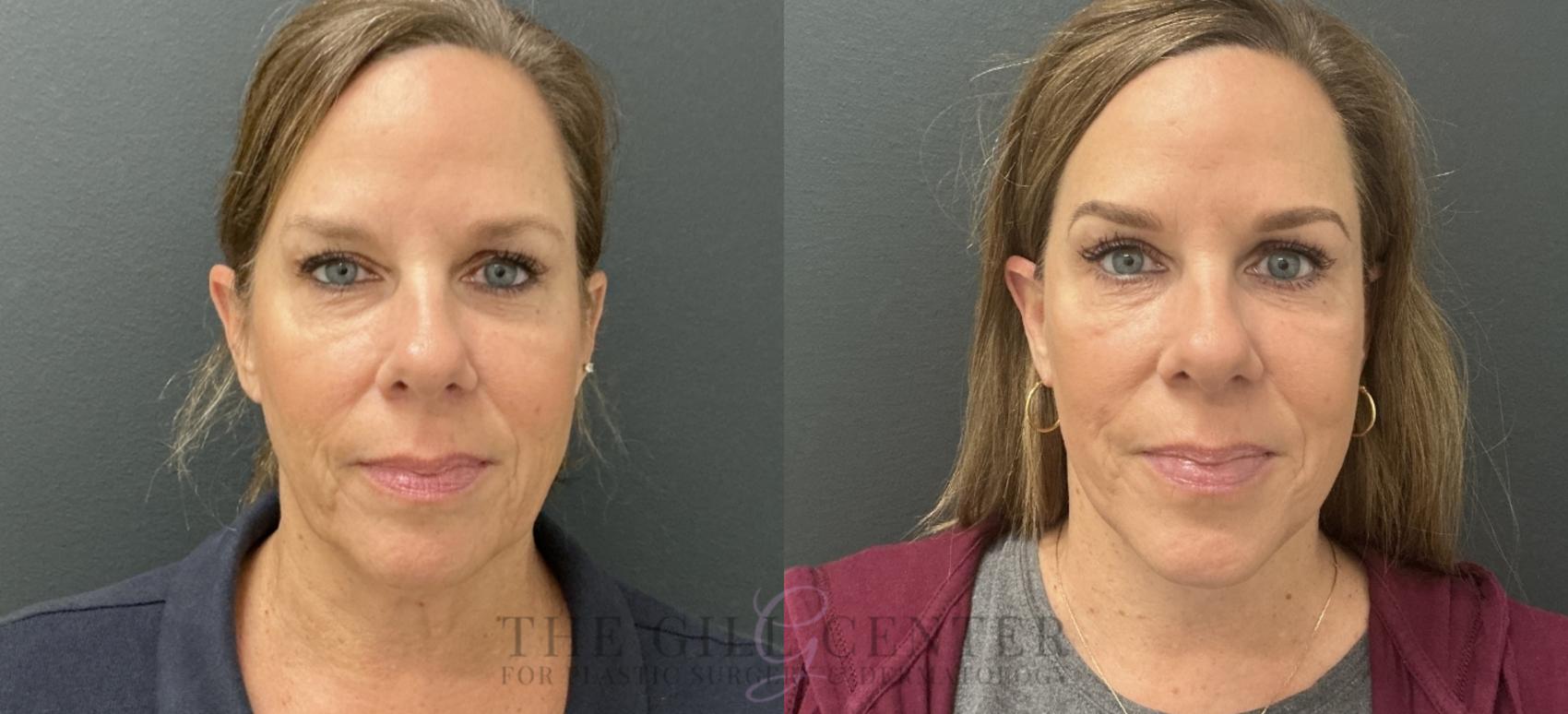 Face & Neck Lift Case 769 Before & After Front | The Woodlands, TX | The Gill Center for Plastic Surgery and Dermatology
