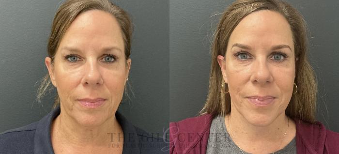 Face & Neck Lift Case 769 Before & After Front | The Woodlands, TX | The Gill Center for Plastic Surgery and Dermatology