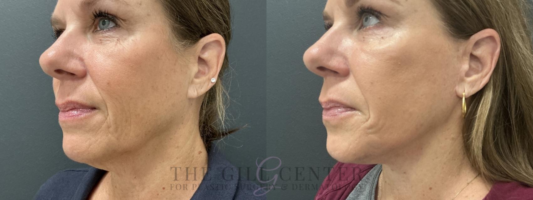 Face & Neck Lift Case 769 Before & After Left lower face  | The Woodlands, TX | The Gill Center for Plastic Surgery and Dermatology