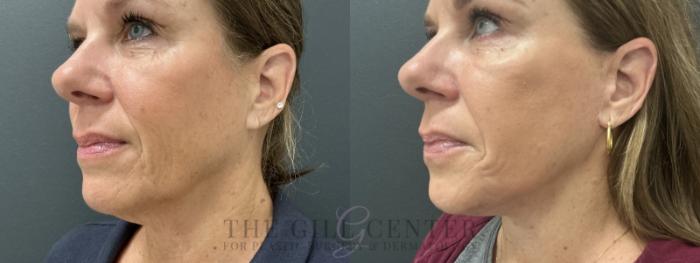 Face & Neck Lift Case 769 Before & After Left lower face  | The Woodlands, TX | The Gill Center for Plastic Surgery and Dermatology