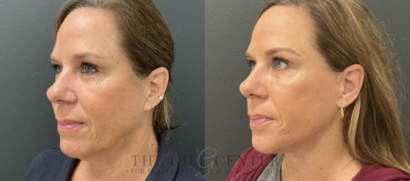 Face & Neck Lift Case 769 Before & After Left Oblique | The Woodlands, TX | The Gill Center for Plastic Surgery and Dermatology