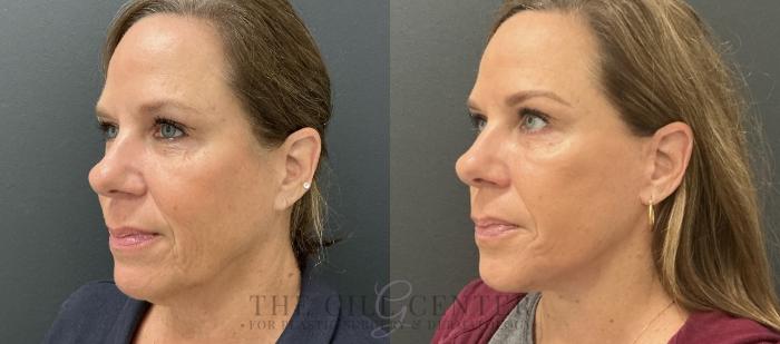 Face & Neck Lift Case 769 Before & After Left Oblique | The Woodlands, TX | The Gill Center for Plastic Surgery and Dermatology