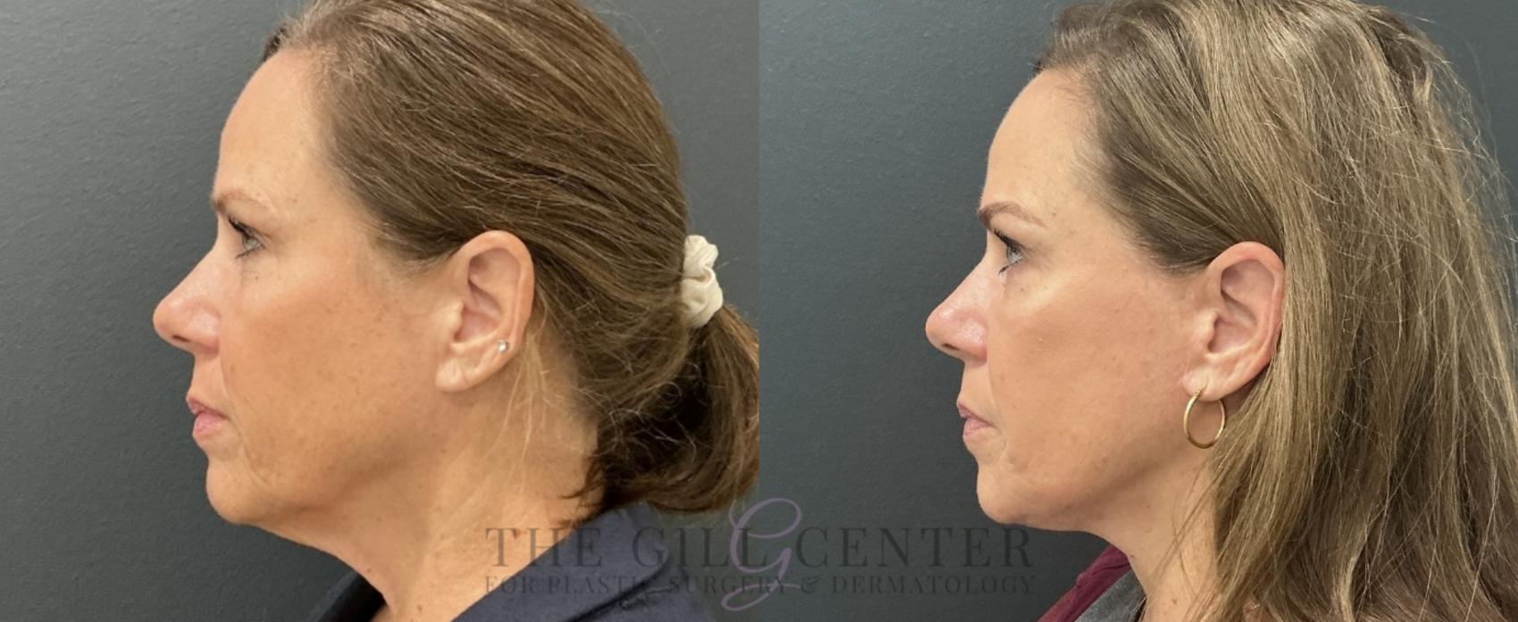 Face & Neck Lift Case 769 Before & After Left Side | The Woodlands, TX | The Gill Center for Plastic Surgery and Dermatology