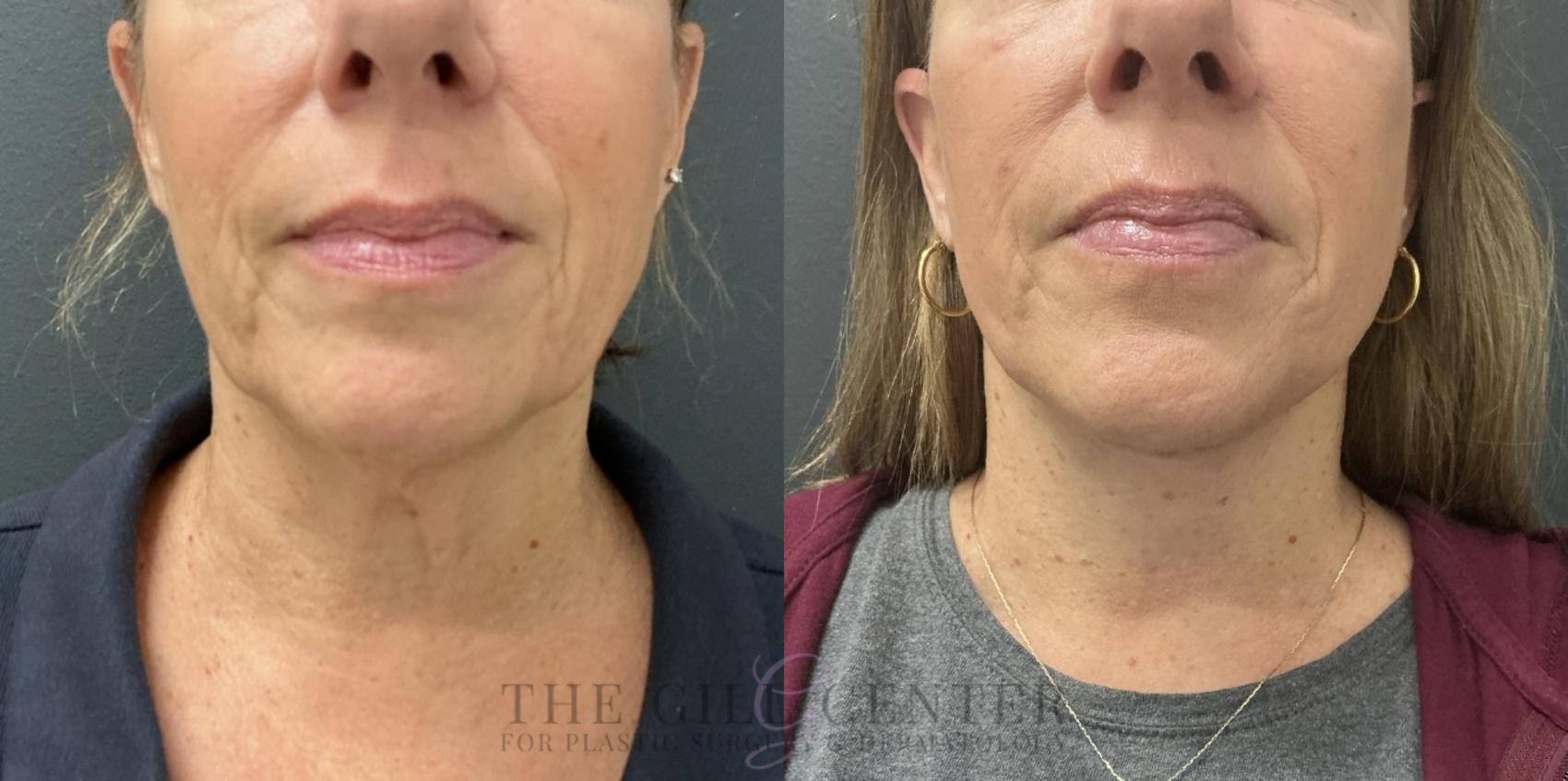 Face & Neck Lift Case 769 Before & After Lower face  | The Woodlands, TX | The Gill Center for Plastic Surgery and Dermatology