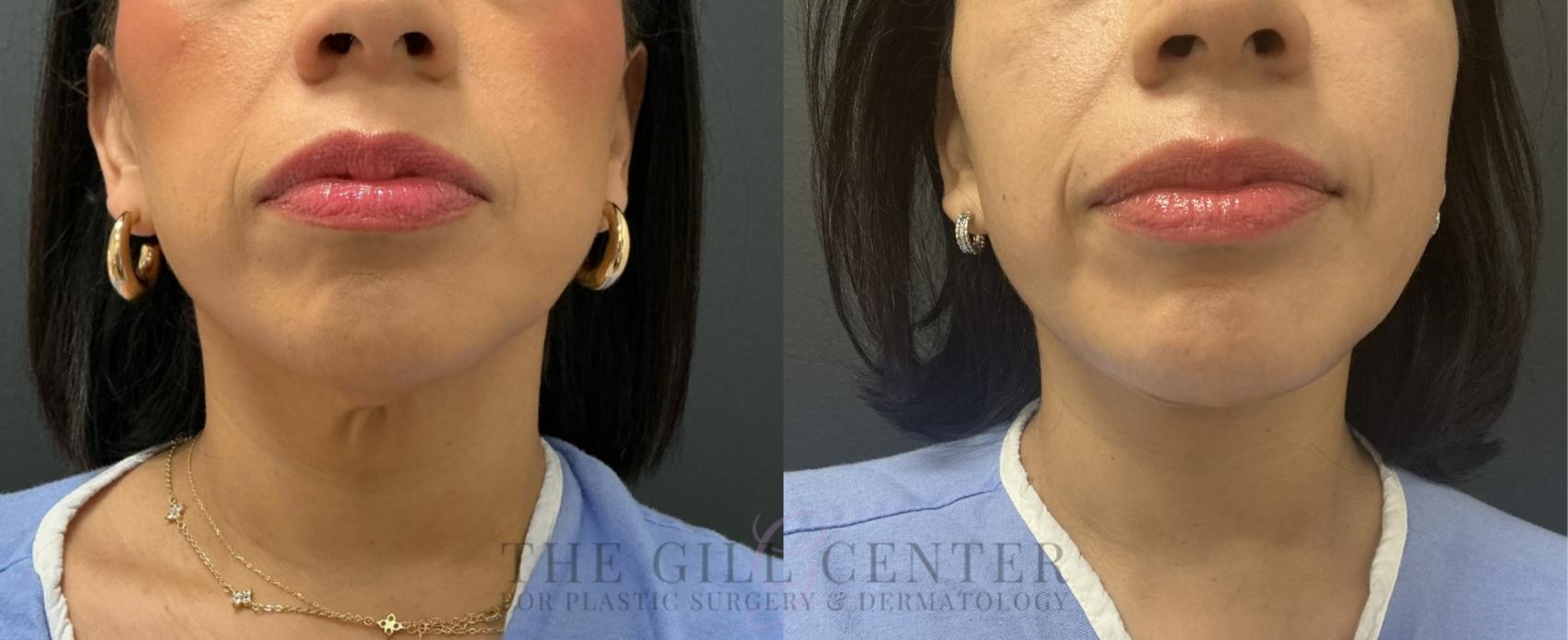 Face & Neck Lift Case 772 Before & After Front | The Woodlands, TX | The Gill Center for Plastic Surgery and Dermatology