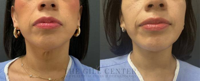 Face & Neck Lift Case 772 Before & After Front | The Woodlands, TX | The Gill Center for Plastic Surgery and Dermatology