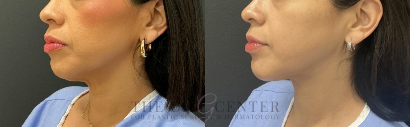 Face & Neck Lift Case 772 Before & After Left Oblique | The Woodlands, TX | The Gill Center for Plastic Surgery and Dermatology
