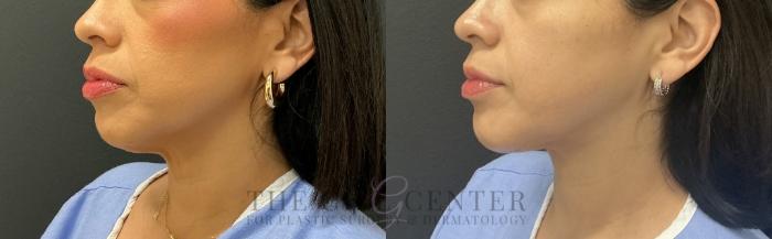 Face & Neck Lift Case 772 Before & After Left Oblique | The Woodlands, TX | The Gill Center for Plastic Surgery and Dermatology