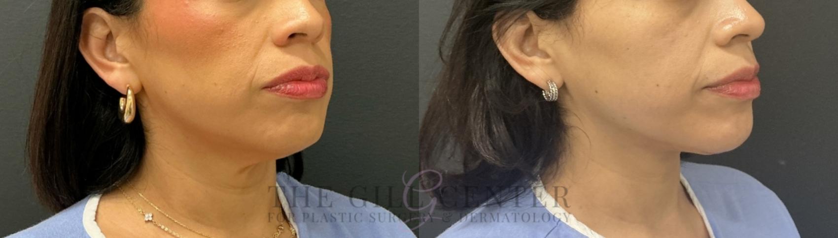 Face & Neck Lift Case 772 Before & After Right Oblique | The Woodlands, TX | The Gill Center for Plastic Surgery and Dermatology