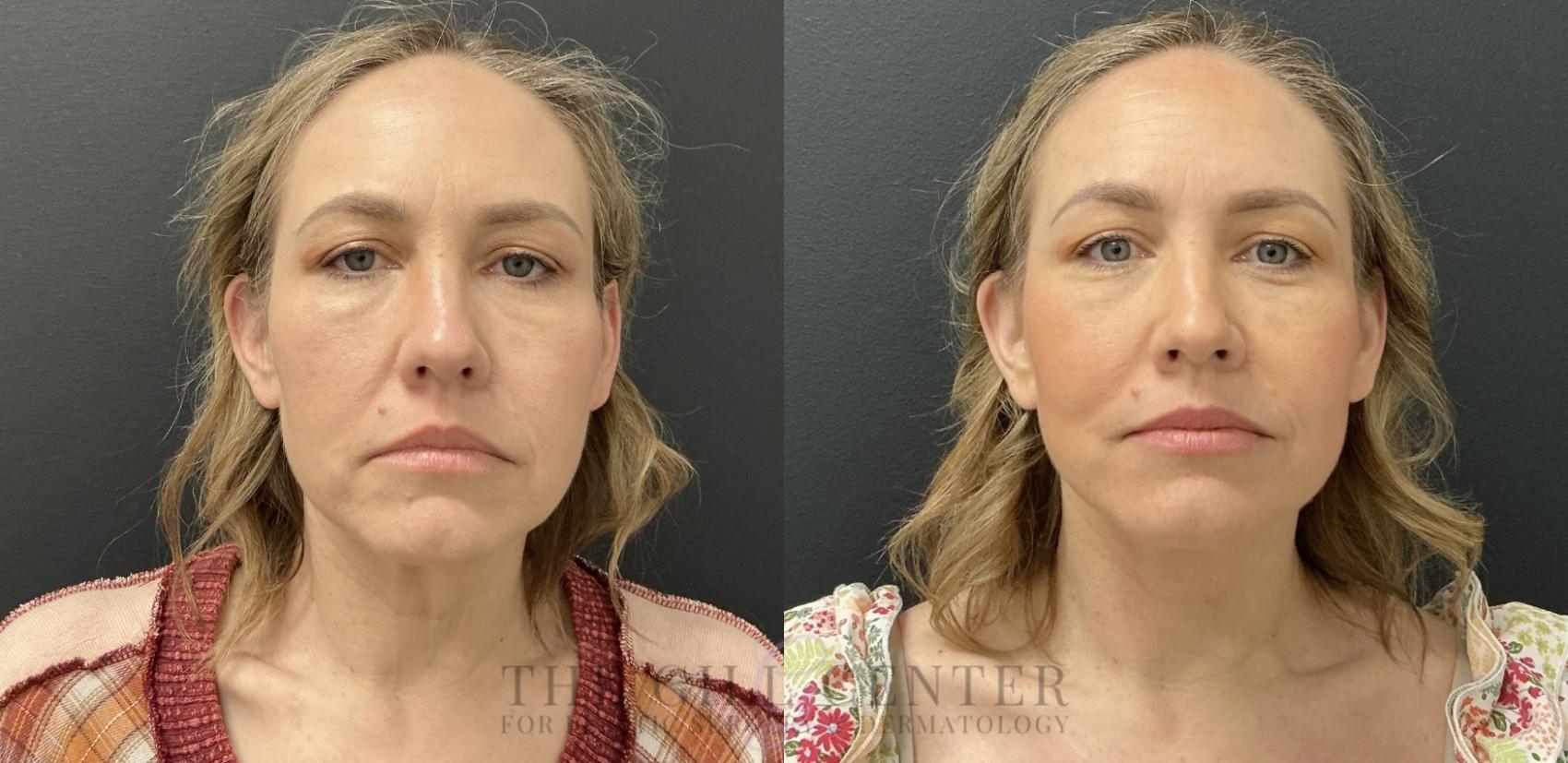 Face & Neck Lift Case 782 Before & After Front | The Woodlands, TX | The Gill Center for Plastic Surgery and Dermatology