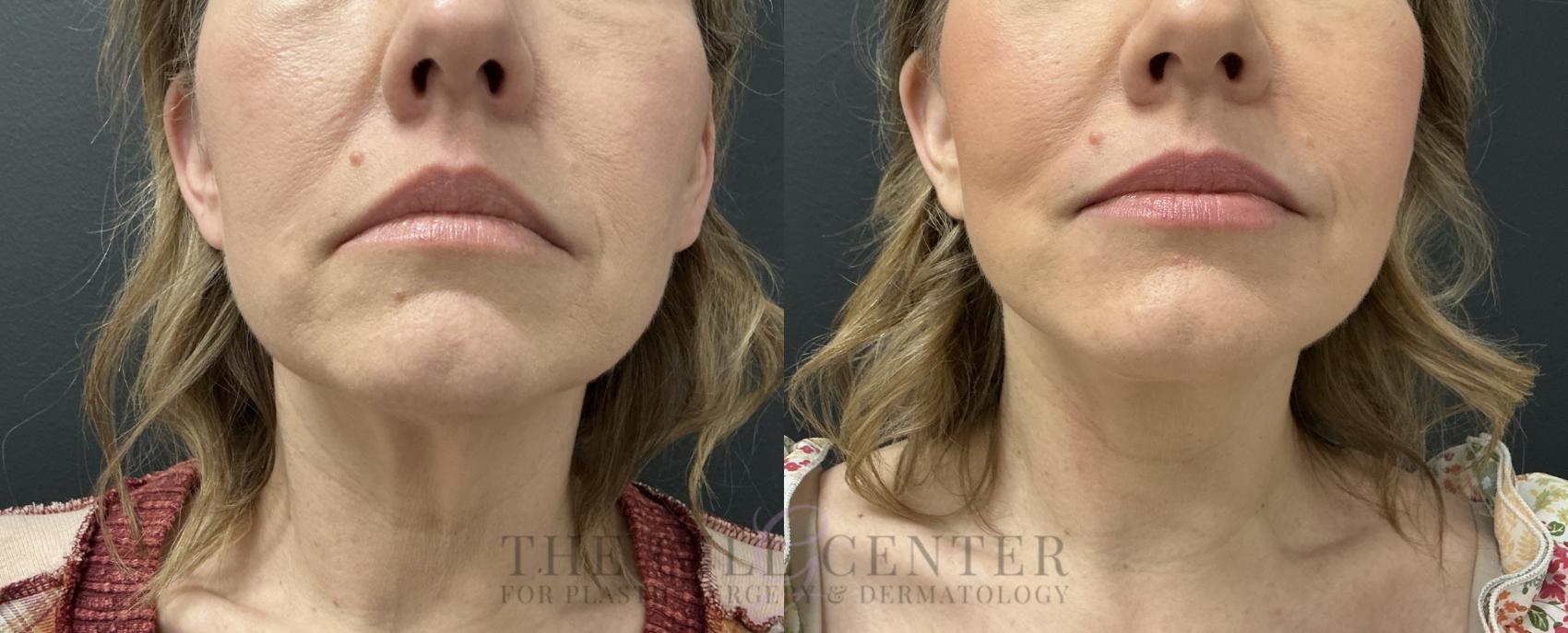 Face & Neck Lift Case 782 Before & After Front lower face/neck | The Woodlands, TX | The Gill Center for Plastic Surgery and Dermatology