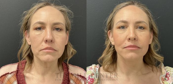 Face & Neck Lift Case 782 Before & After Front | The Woodlands, TX | The Gill Center for Plastic Surgery and Dermatology