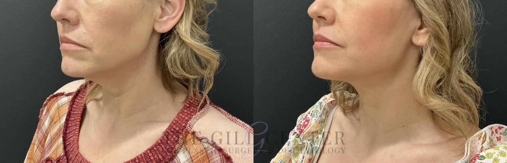 Face & Neck Lift Case 782 Before & After Left Oblique | The Woodlands, TX | The Gill Center for Plastic Surgery and Dermatology