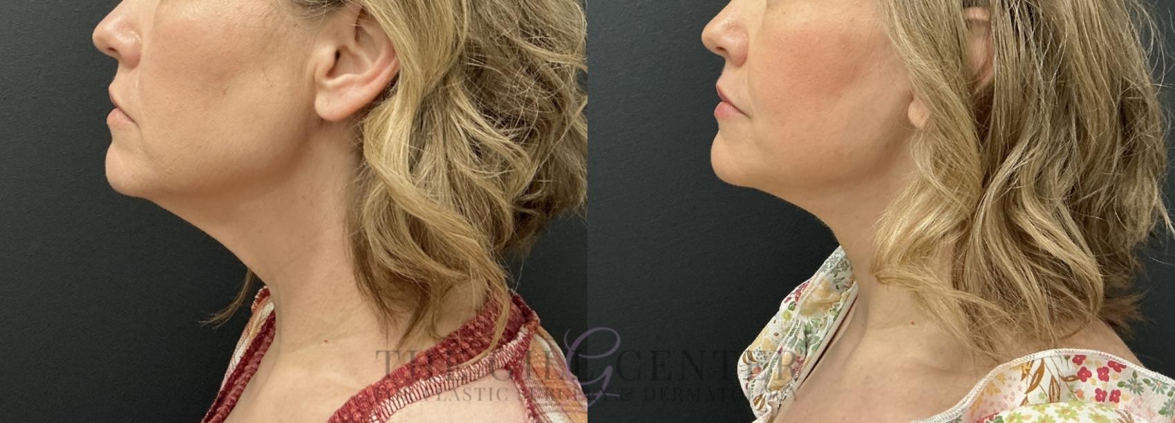 Face & Neck Lift Case 782 Before & After Left Side | The Woodlands, TX | The Gill Center for Plastic Surgery and Dermatology