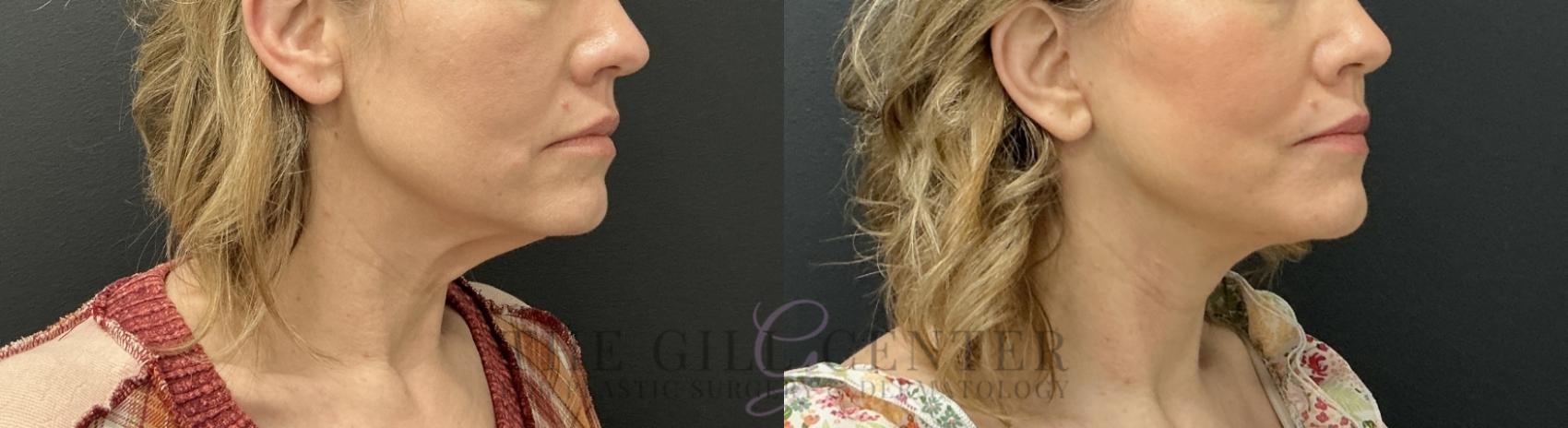 Face & Neck Lift Case 782 Before & After Right Oblique | The Woodlands, TX | The Gill Center for Plastic Surgery and Dermatology