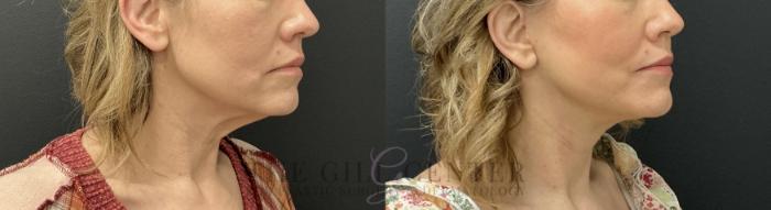 Face & Neck Lift Case 782 Before & After Right Oblique | The Woodlands, TX | The Gill Center for Plastic Surgery and Dermatology