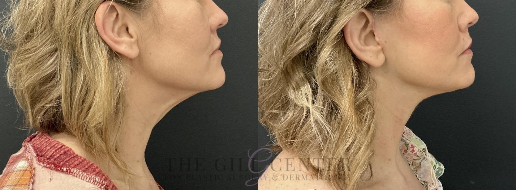 Face & Neck Lift Case 782 Before & After Right Side | The Woodlands, TX | The Gill Center for Plastic Surgery and Dermatology