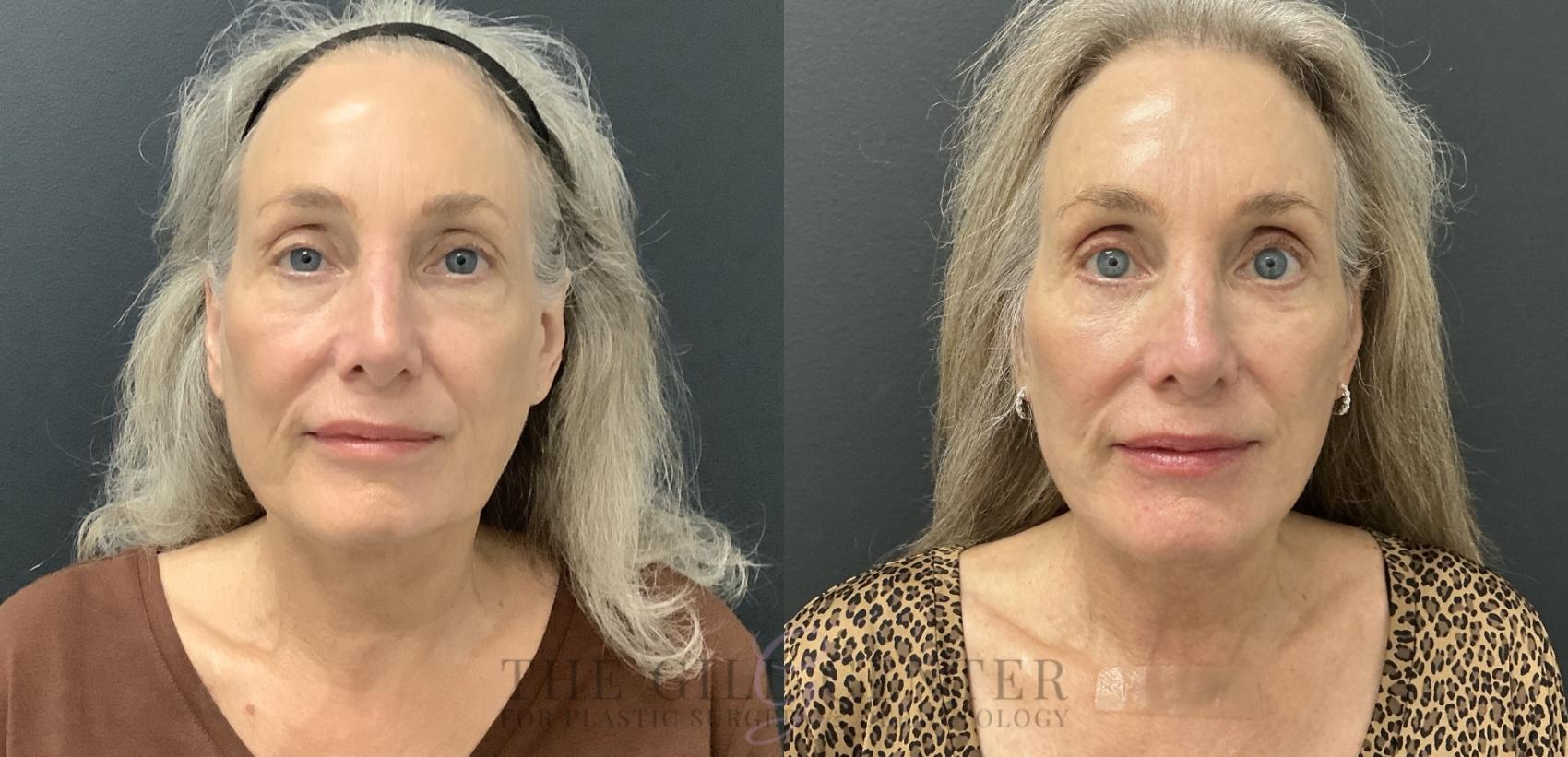 Face & Neck Lift Case 783 Before & After Front | The Woodlands, TX | The Gill Center for Plastic Surgery and Dermatology