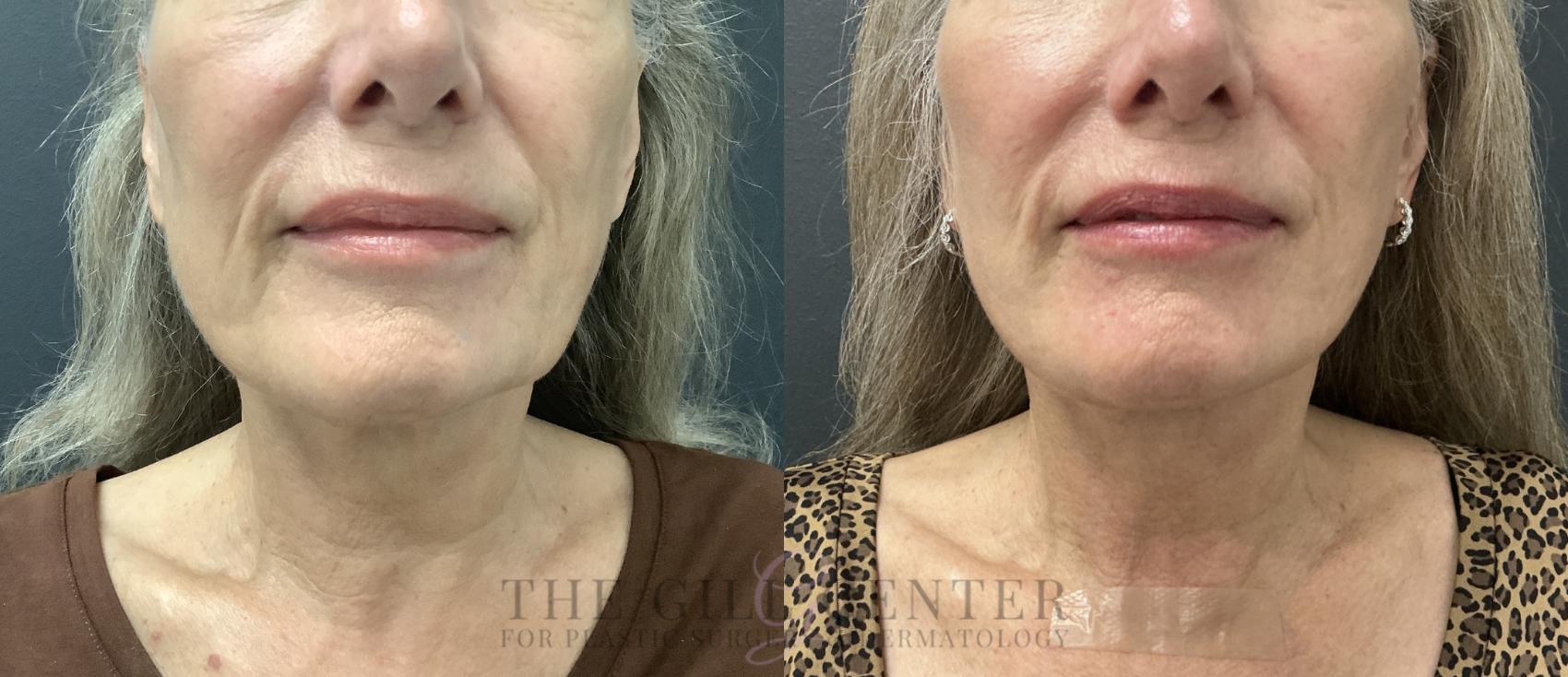 Face & Neck Lift Case 783 Before & After Front lower face/neck | The Woodlands, TX | The Gill Center for Plastic Surgery and Dermatology