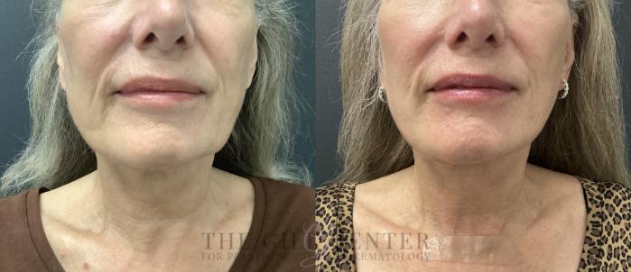 Face & Neck Lift Case 783 Before & After Front lower face/neck | The Woodlands, TX | The Gill Center for Plastic Surgery and Dermatology