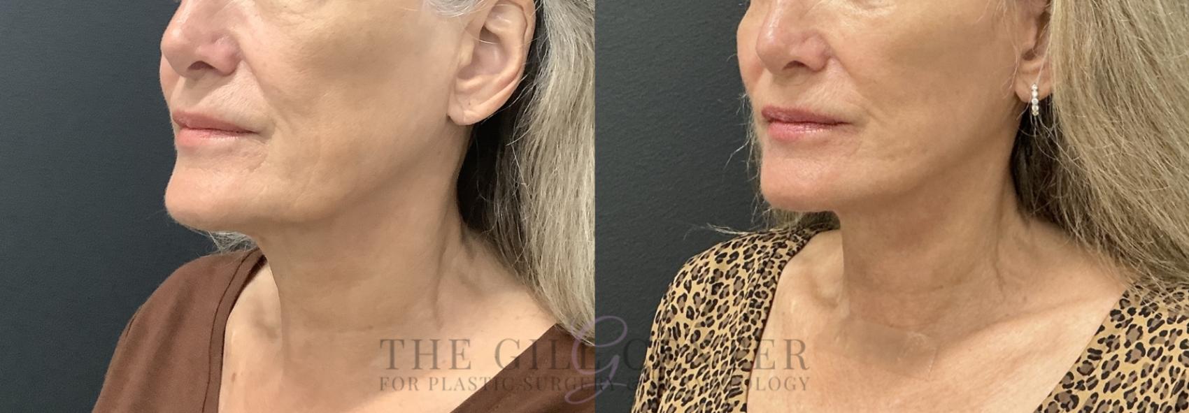 Face & Neck Lift Case 783 Before & After Left Oblique | The Woodlands, TX | The Gill Center for Plastic Surgery and Dermatology