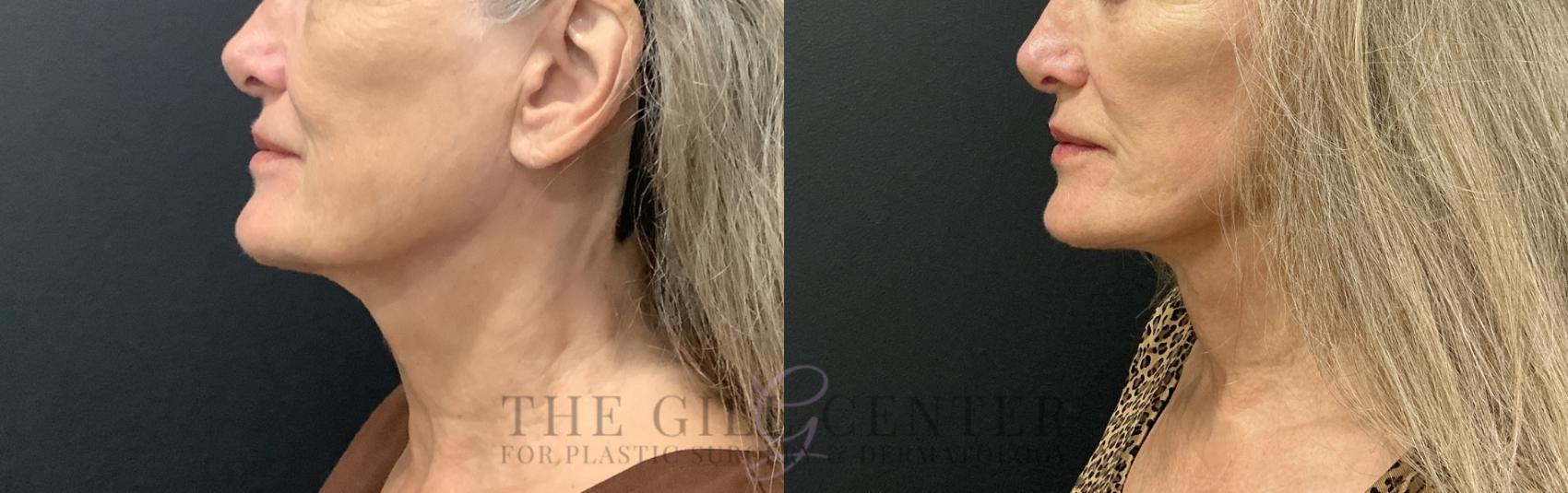 Face & Neck Lift Case 783 Before & After Left Side | The Woodlands, TX | The Gill Center for Plastic Surgery and Dermatology