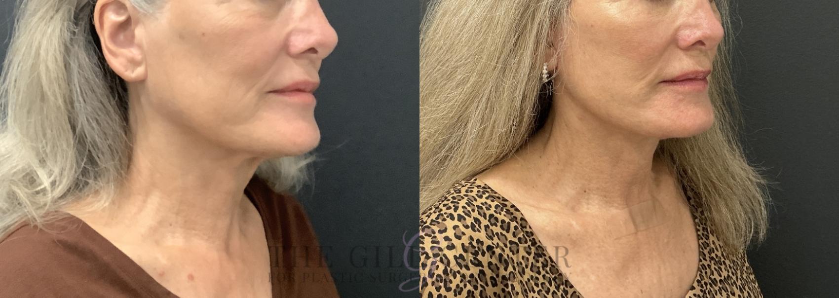 Face & Neck Lift Case 783 Before & After Right Oblique | The Woodlands, TX | The Gill Center for Plastic Surgery and Dermatology