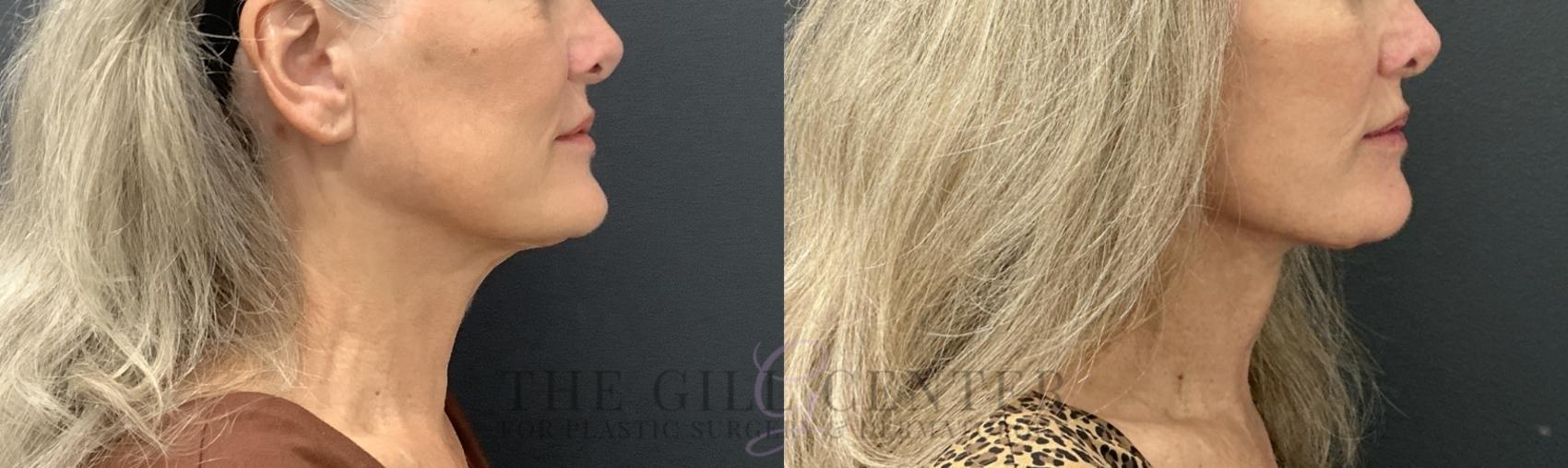 Face & Neck Lift Case 783 Before & After Right Side | The Woodlands, TX | The Gill Center for Plastic Surgery and Dermatology