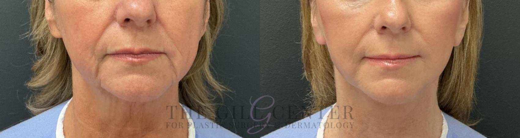 Face & Neck Lift Case 800 Before & After Front | The Woodlands, TX | The Gill Center for Plastic Surgery and Dermatology