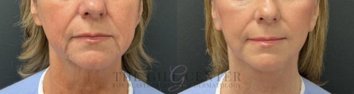 Face & Neck Lift Case 800 Before & After Front | The Woodlands, TX | The Gill Center for Plastic Surgery and Dermatology