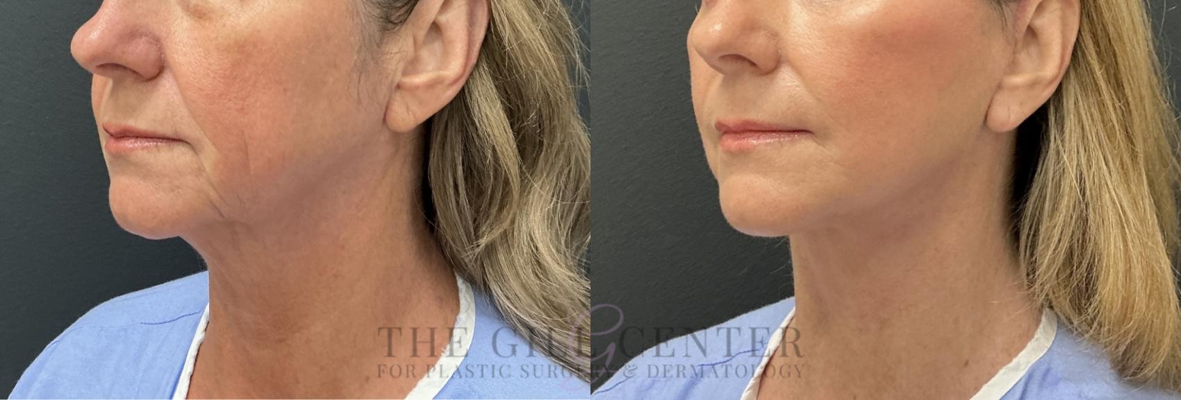 Face & Neck Lift Case 800 Before & After Left Oblique | The Woodlands, TX | The Gill Center for Plastic Surgery and Dermatology