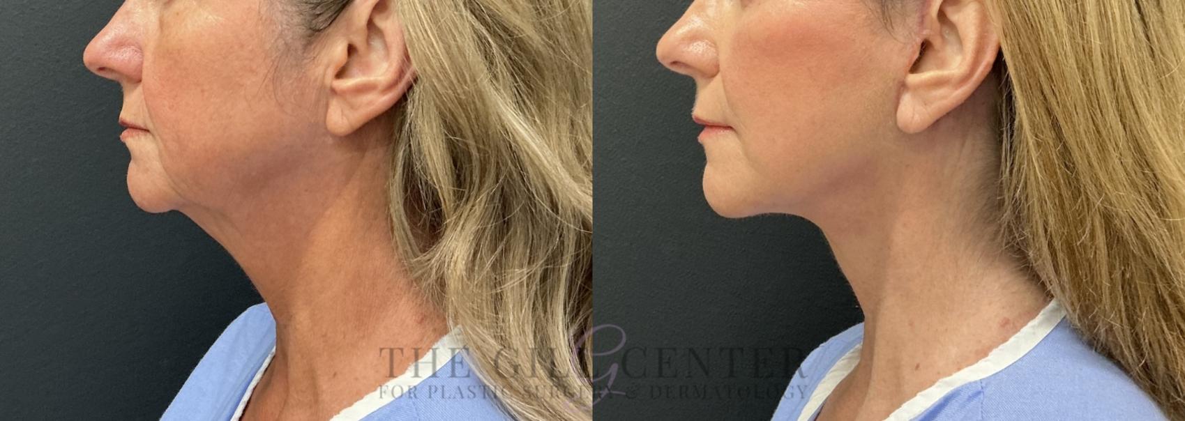 Face & Neck Lift Case 800 Before & After Left Side | The Woodlands, TX | The Gill Center for Plastic Surgery and Dermatology