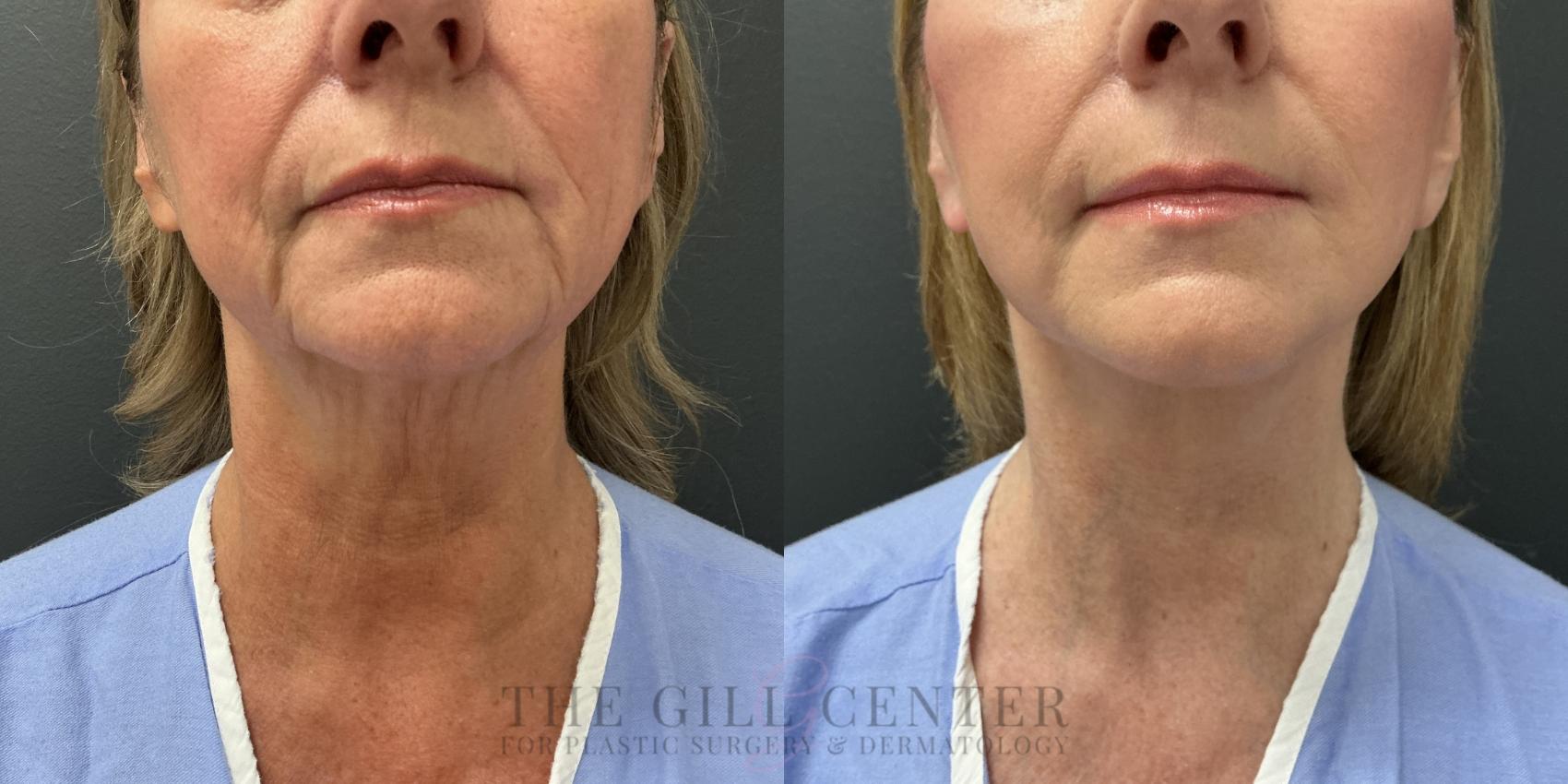 Face & Neck Lift Case 800 Before & After Lower face | The Woodlands, TX | The Gill Center for Plastic Surgery and Dermatology