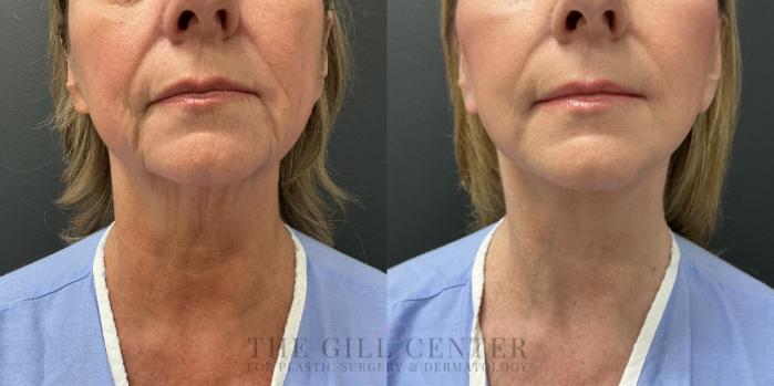 Face & Neck Lift Case 800 Before & After Lower face | The Woodlands, TX | The Gill Center for Plastic Surgery and Dermatology