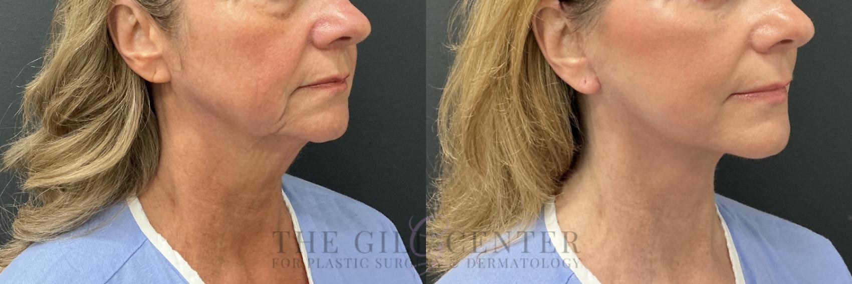Face & Neck Lift Case 800 Before & After Right Oblique | The Woodlands, TX | The Gill Center for Plastic Surgery and Dermatology