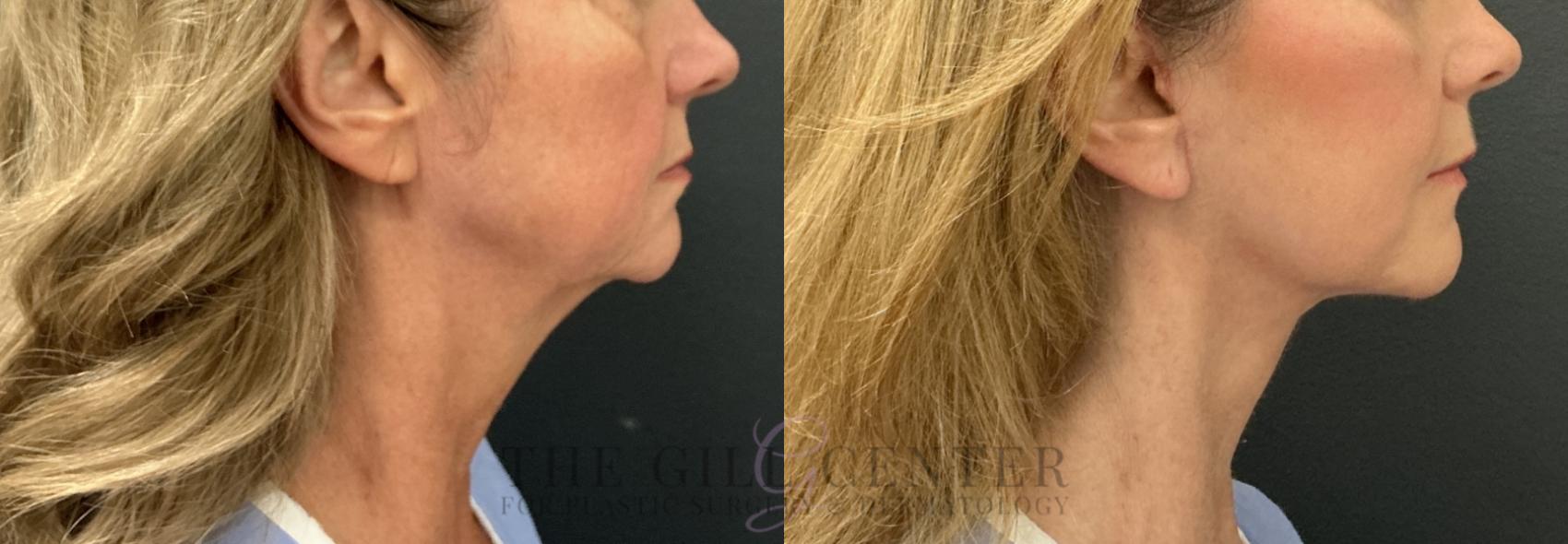 Face & Neck Lift Case 800 Before & After Right Side | The Woodlands, TX | The Gill Center for Plastic Surgery and Dermatology