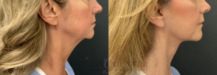 Face & Neck Lift Case 800 Before & After Right Side | The Woodlands, TX | The Gill Center for Plastic Surgery and Dermatology
